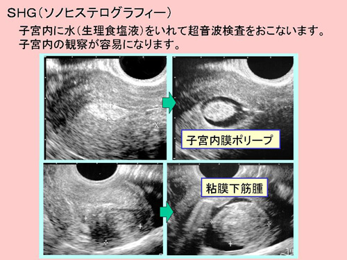 子宮内の検査－ソノヒステログラフィーと子宮鏡図解 1
