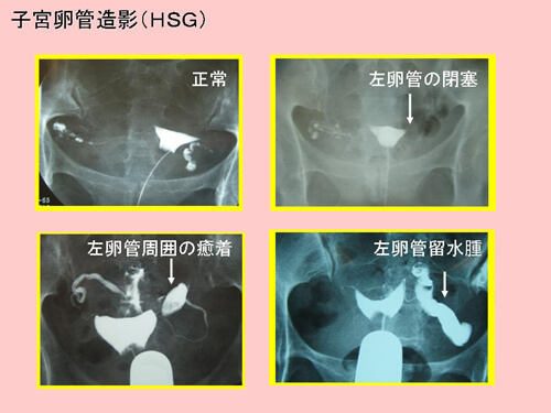 子宮卵管造影検査図解 2
