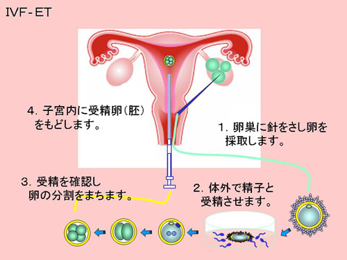 体外受精－胚移植図解