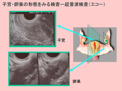 超音波検査（卵巣・子宮）図解