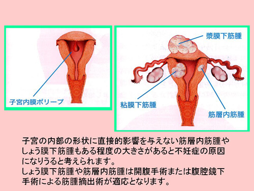 子宮因子図解