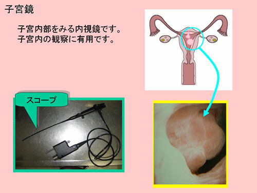 子宮内の検査－ソノヒステログラフィーと子宮鏡図解 2