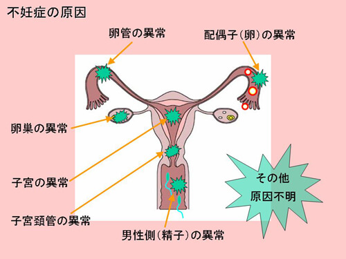 不妊症の原因図解