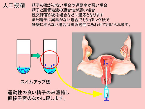人工授精図解