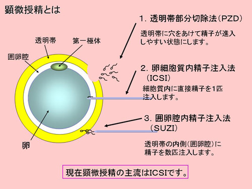 顕微授精図解