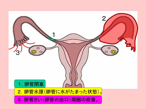 卵管因子図解
