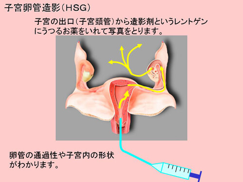子宮卵管造影検査図解 1