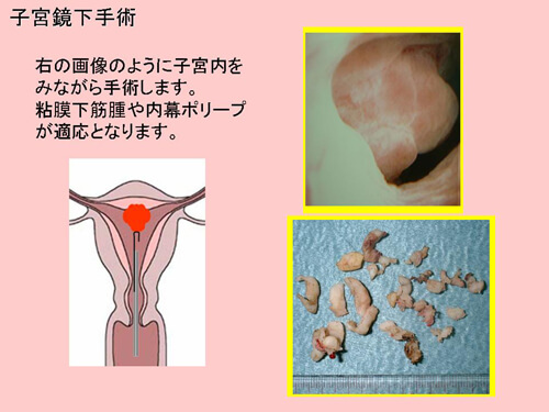 子宮鏡下手術図解