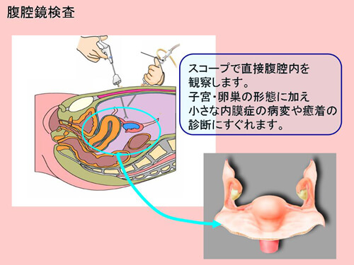 腹腔鏡検査図解