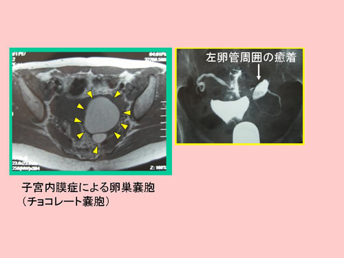 子宮内膜症